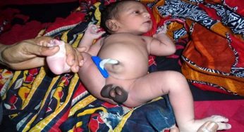 দু’পুরুষাঙ্গ নিয়ে শিশুর জন্ম (ভিডিও)