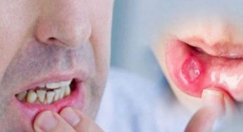 মুখের ঘা হতে পারে কোন মারণব্যধির সংকেত!