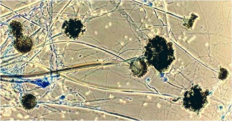 দেশে দুজনের শরীরে ‘ব্ল্যাক ফাঙ্গাস’ শনাক্ত