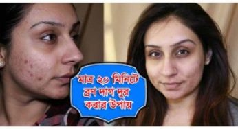 মাত্র ২০ মিনিটে ব্রণের দাগ দূর করার উপায় (ভিডিও)